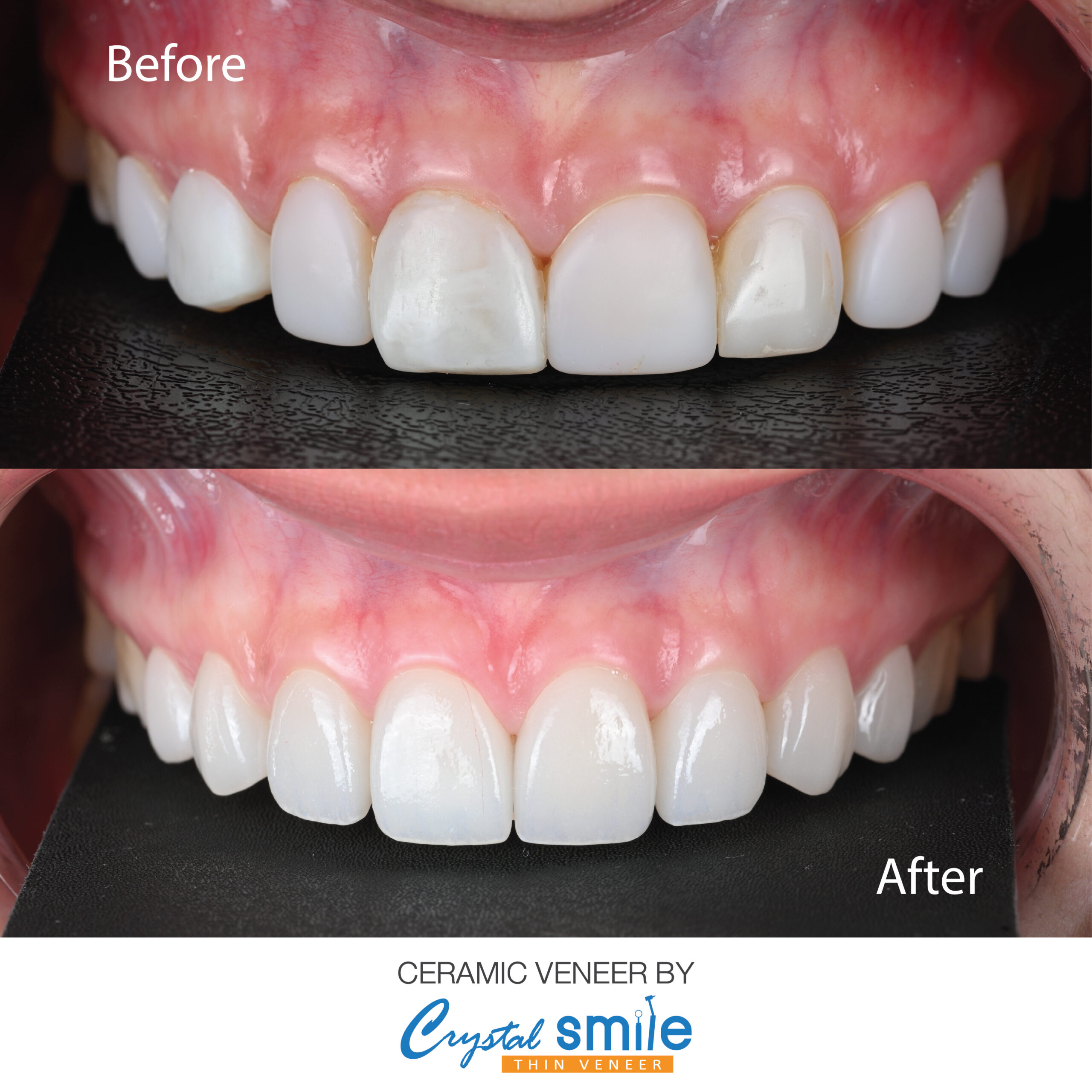 เคสวีเนียร์-11